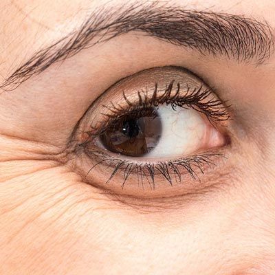 Eye with signs of aging